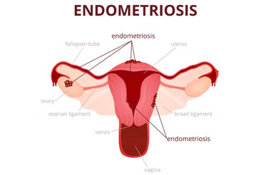 6 Things Every Woman Needs To Know About Endometriosis