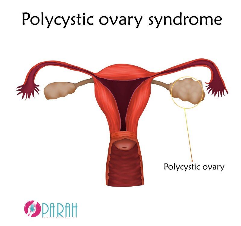 How PCOS Affects Fertility